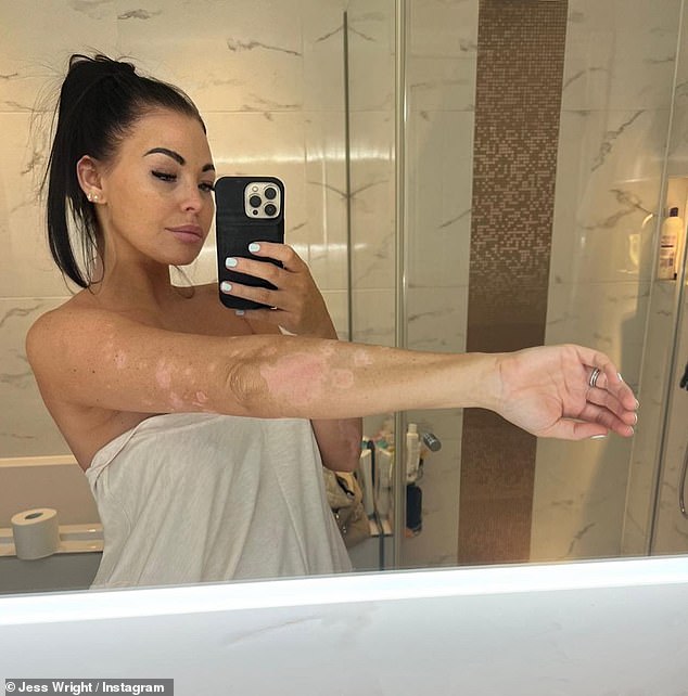 Candid: Jess recently bravely shared a series of candid photos from her ongoing battle with psoriasis, an autoimmune condition